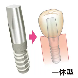 インプラント治療とは | AQB